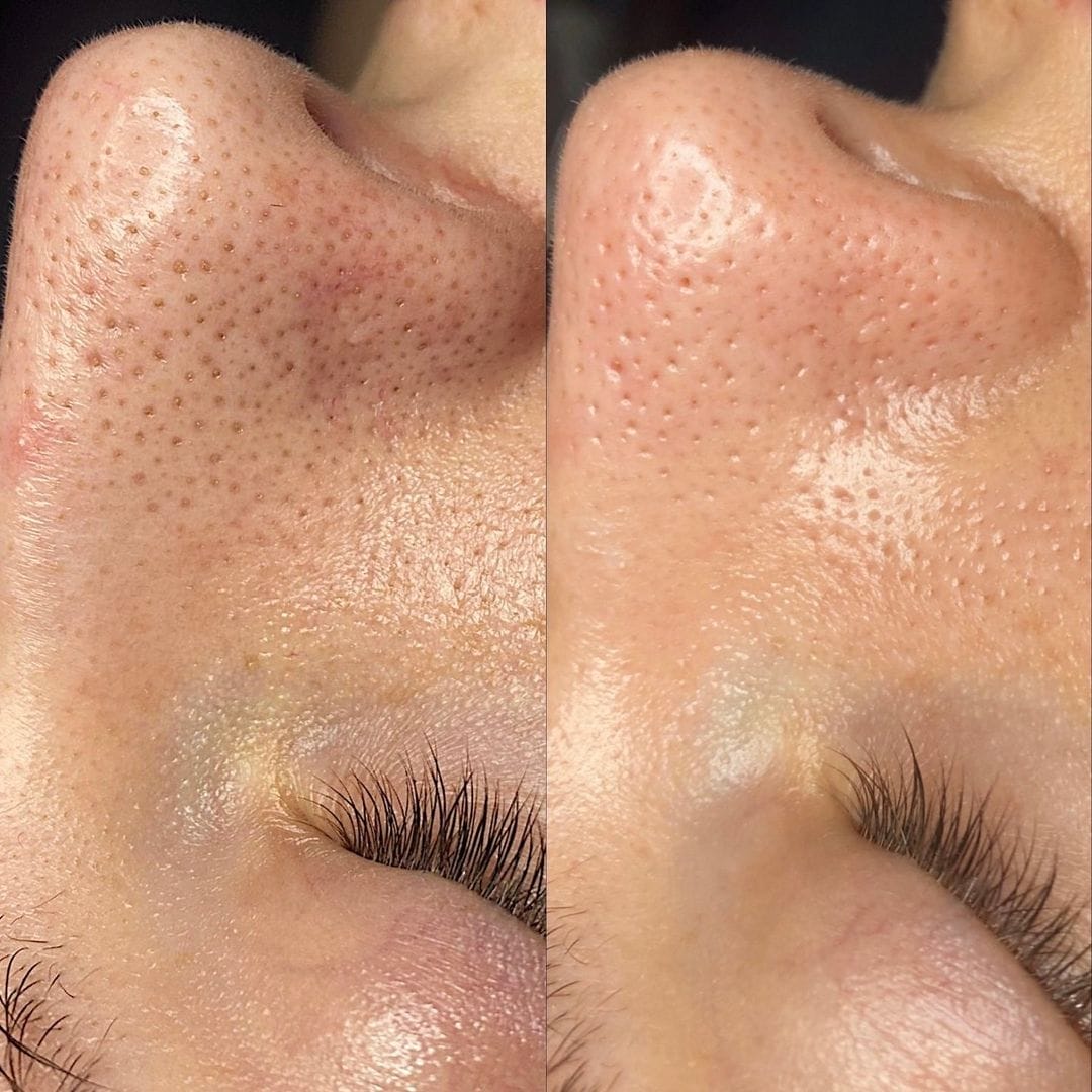 M∙A∙C∙Clinic Syndeo Hydrafacial result