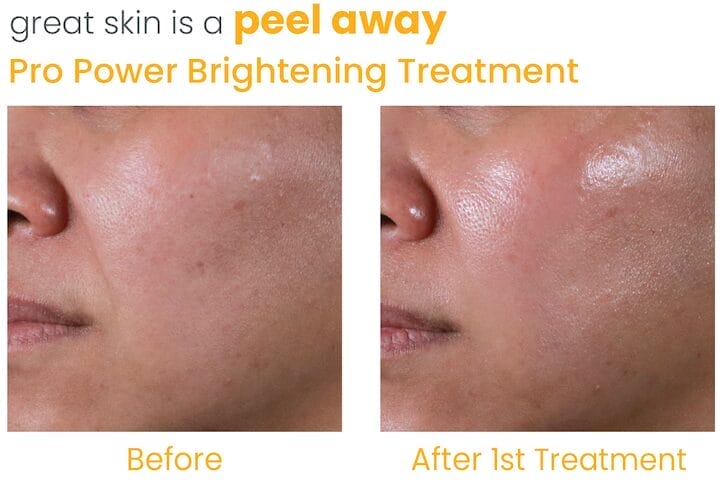 Pro Power Brightening Treatment_treatment before and after -01